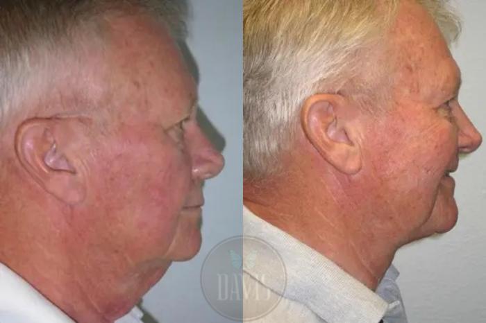 Before & After Neck Lift Case 1032 View 1 View in Tampa, FL