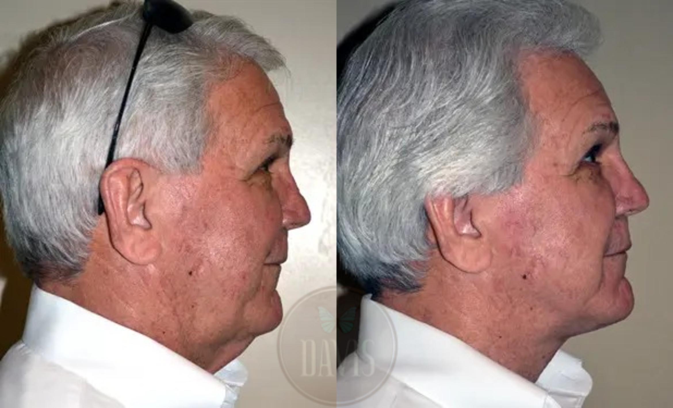 Before & After Neck Lift Case 1033 View 1 View in Tampa, FL