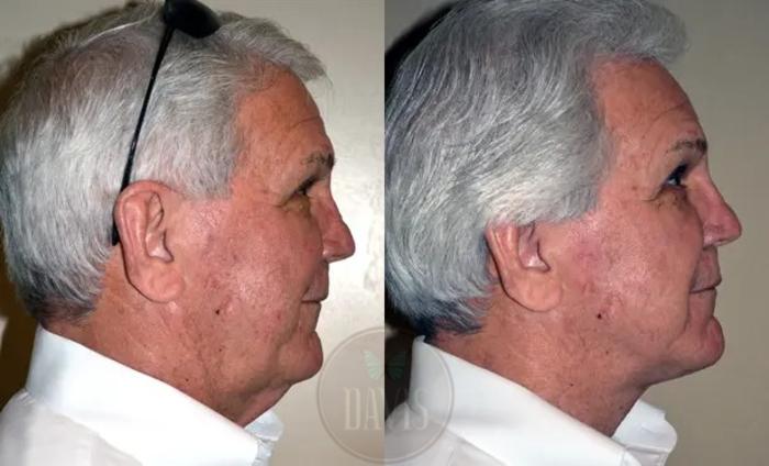 Before & After Neck Lift Case 1033 View 1 View in Tampa, FL