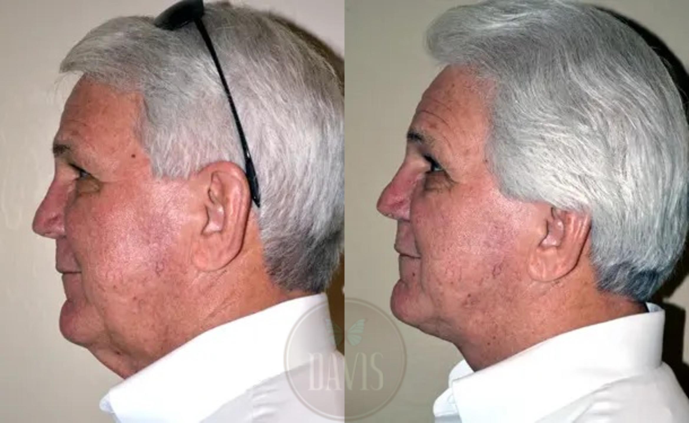 Before & After Neck Lift Case 1033 View 2 View in Tampa, FL