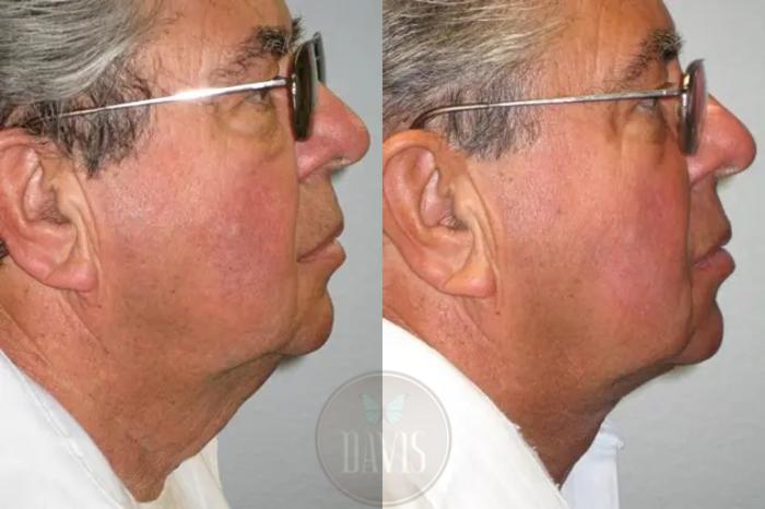 Before & After Neck Lift Case 1034 View 1 View in Tampa, FL