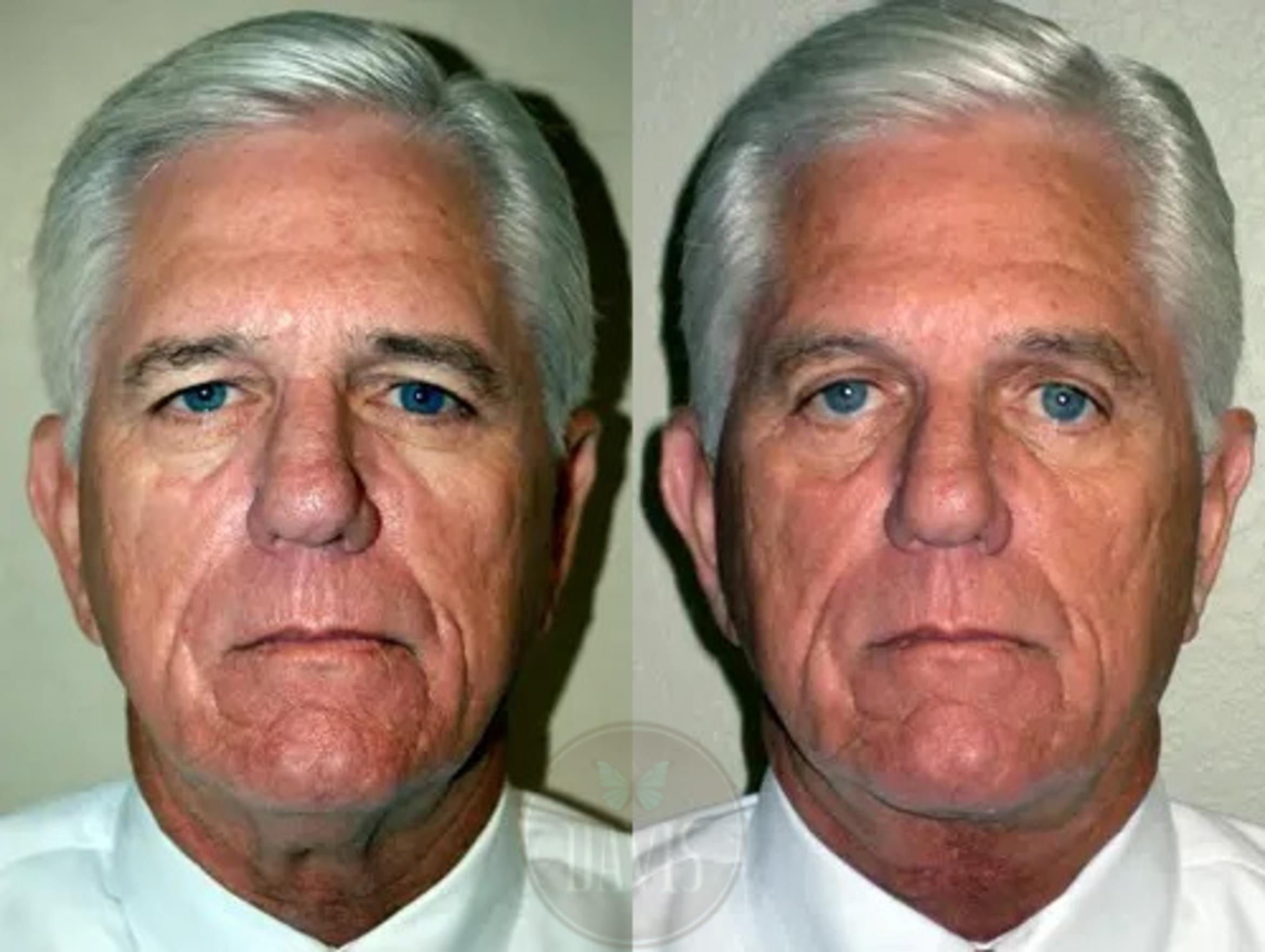 Before & After Neck Lift Case 1035 View 2 View in Tampa, FL