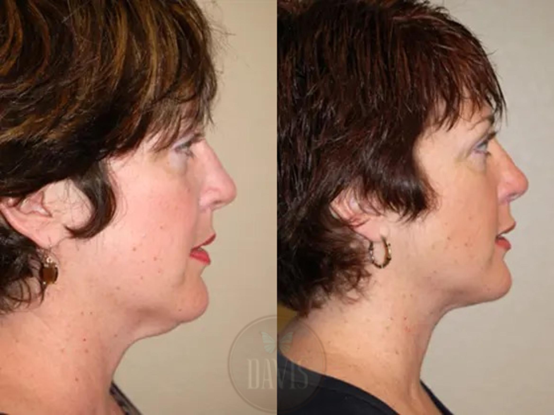 Before & After Neck Lift Case 1036 View 1 View in Tampa, FL