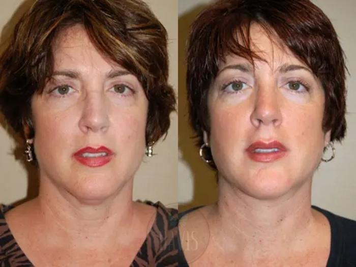 Before & After Neck Lift Case 1036 View 2 View in Tampa, FL
