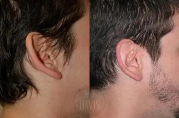 Before & After Otoplasty Case 1026 View 1 View in Tampa, FL