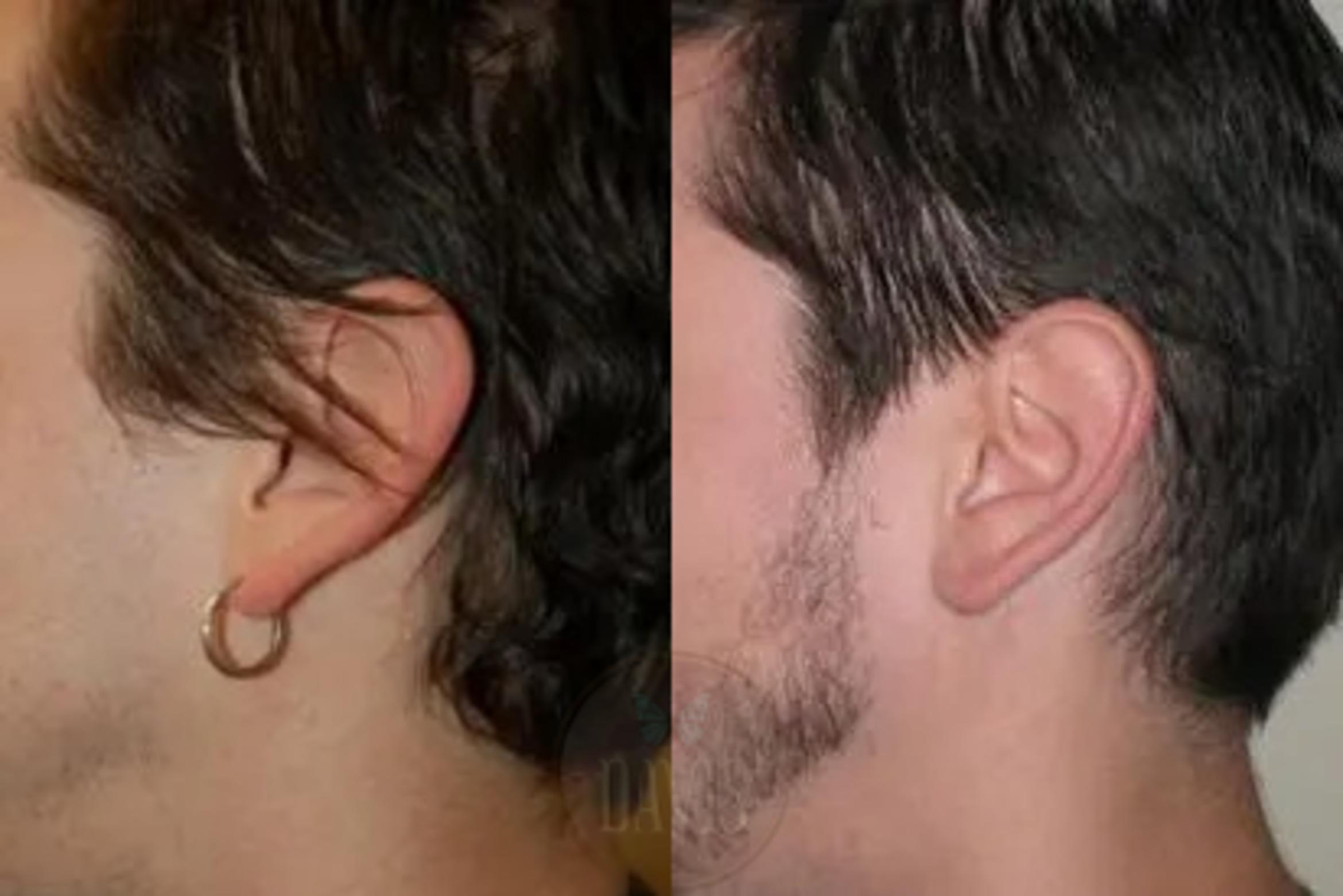 Before & After Otoplasty Case 1026 View 2 View in Tampa, FL