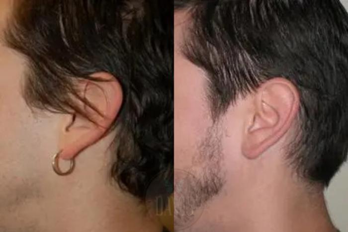 Before & After Otoplasty Case 1026 View 2 View in Tampa, FL