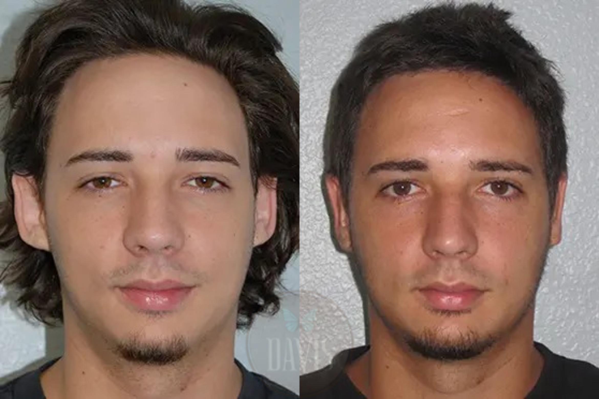 Before & After Otoplasty Case 1027 View 1 View in Tampa, FL