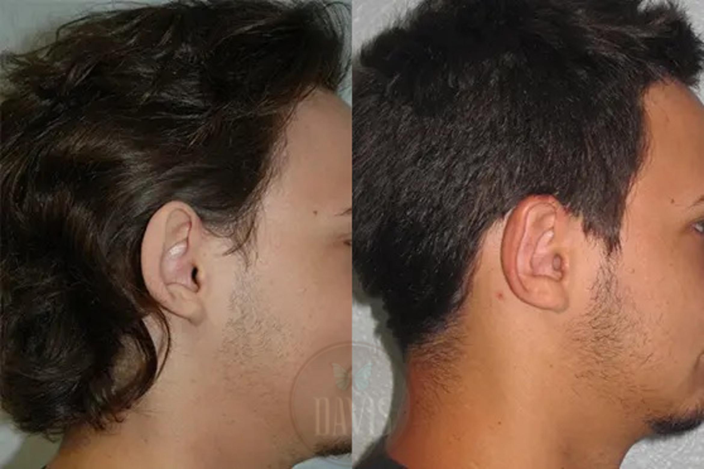 Before & After Otoplasty Case 1027 View 2 View in Tampa, FL