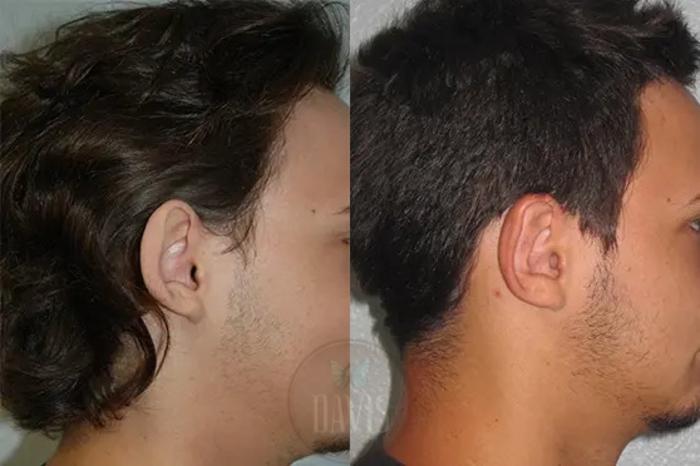 Before & After Otoplasty Case 1027 View 2 View in Tampa, FL