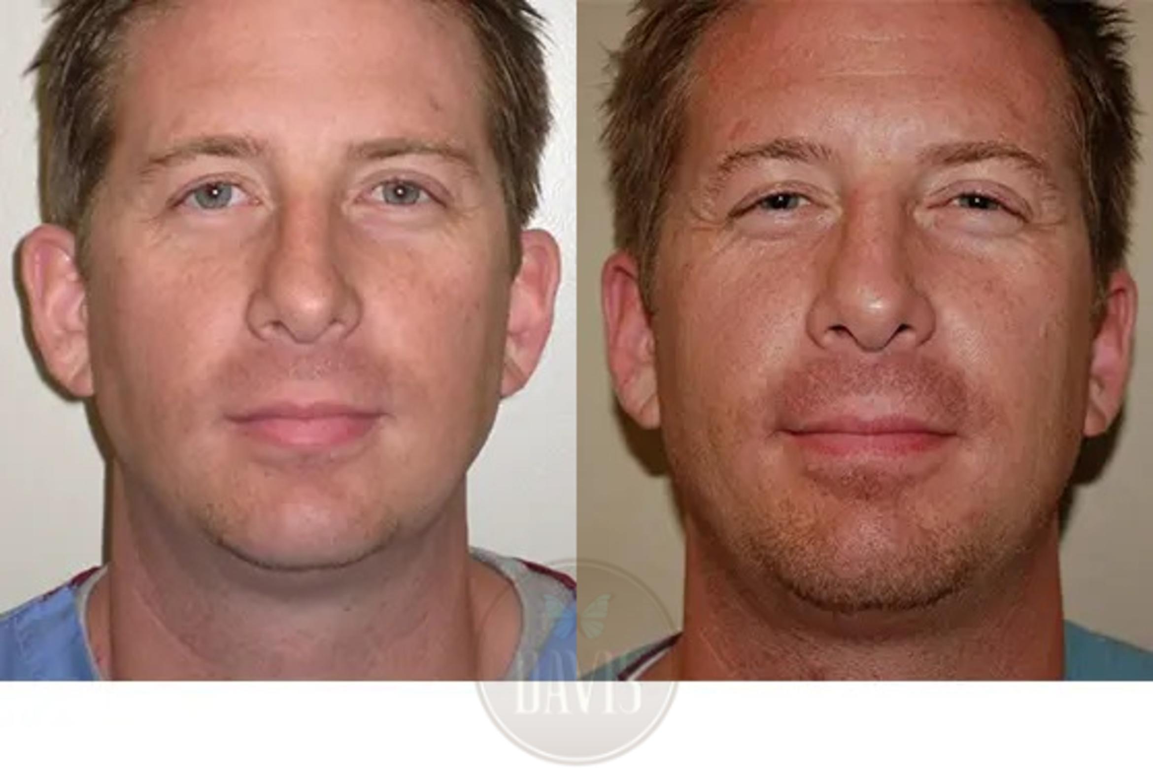 Before & After Otoplasty Case 1028 View 1 View in Tampa, FL