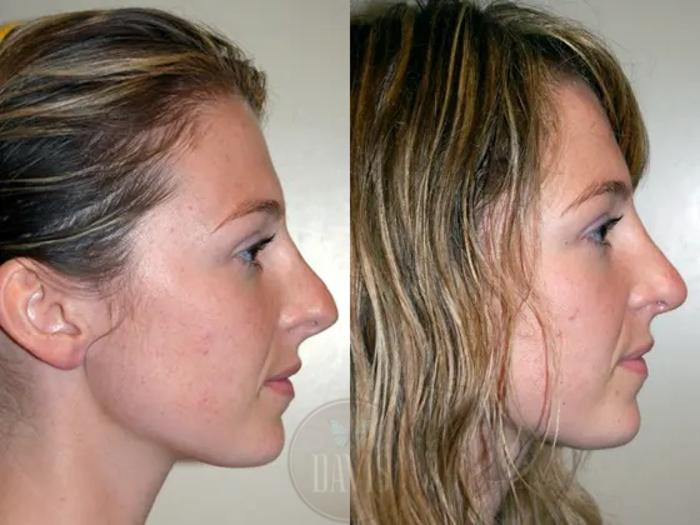 Before & After Revision Rhinoplasty Case 1020 View 1 View in Tampa, FL
