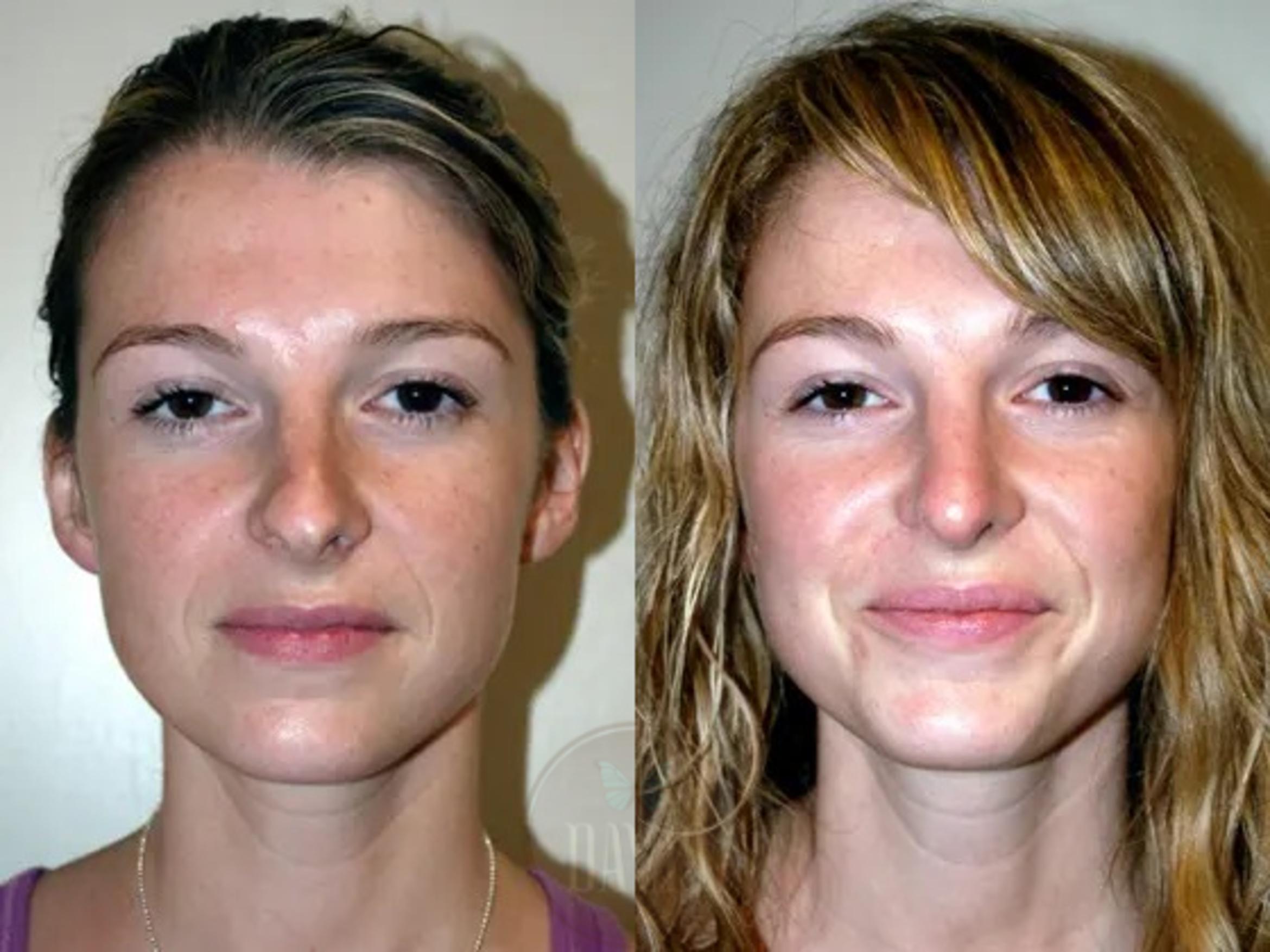 Before & After Revision Rhinoplasty Case 1020 View 2 View in Tampa, FL