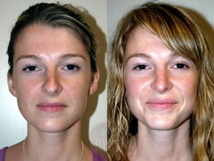 Before & After Revision Rhinoplasty Case 1020 View 2 View in Tampa, FL