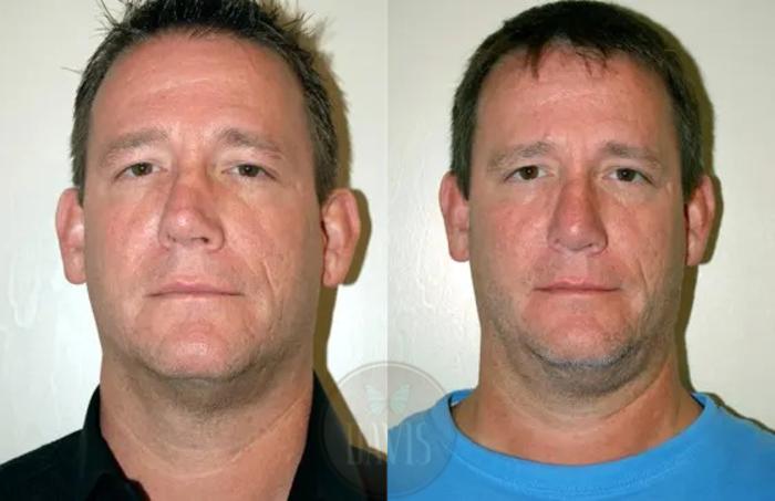 Before & After Revision Rhinoplasty Case 1021 View 1 View in Tampa, FL