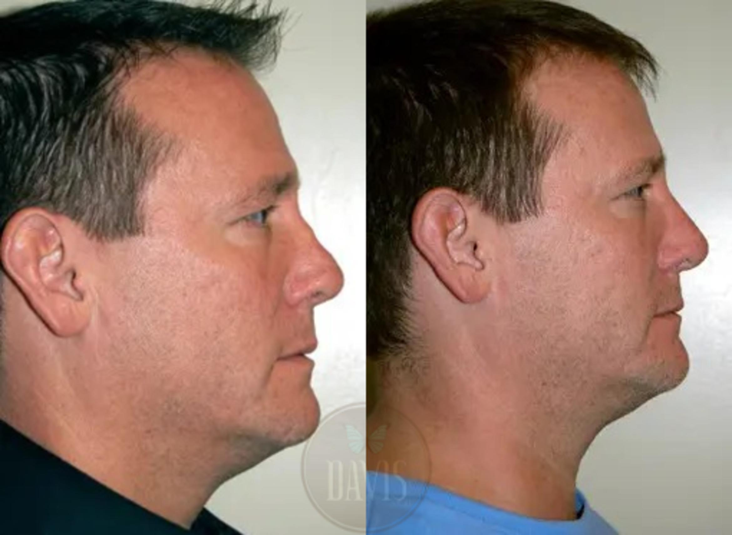 Before & After Revision Rhinoplasty Case 1021 View 2 View in Tampa, FL