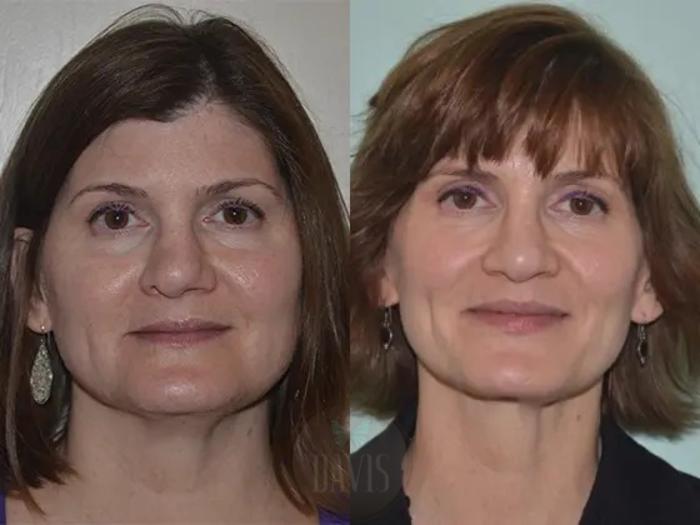 Before & After Revision Rhinoplasty Case 1022 View 1 View in Tampa, FL