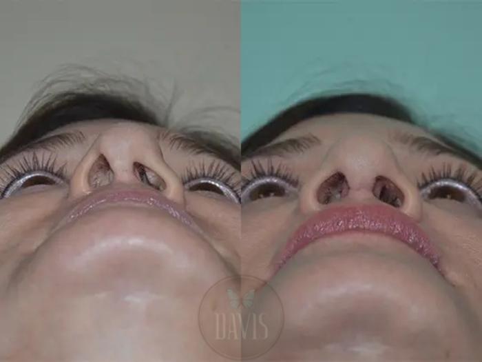 Before & After Revision Rhinoplasty Case 1022 View 2 View in Tampa, FL