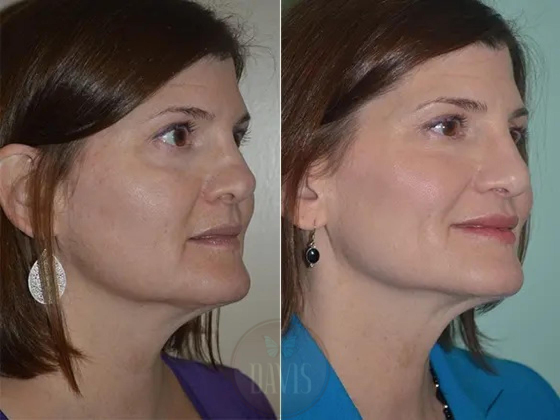 Before & After Revision Rhinoplasty Case 1022 View 3 View in Tampa, FL