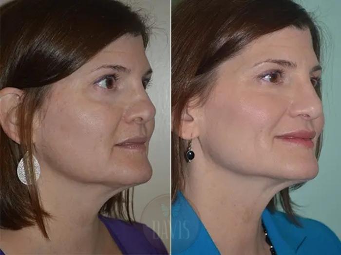 Before & After Revision Rhinoplasty Case 1022 View 3 View in Tampa, FL