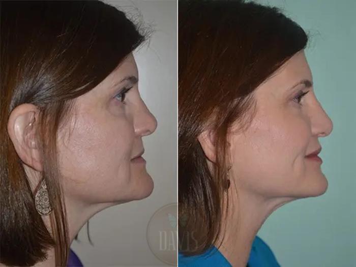 Before & After Revision Rhinoplasty Case 1022 View 4 View in Tampa, FL