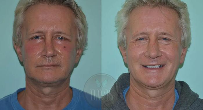 Before & After Revision Rhinoplasty Case 1023 View 1 View in Tampa, FL