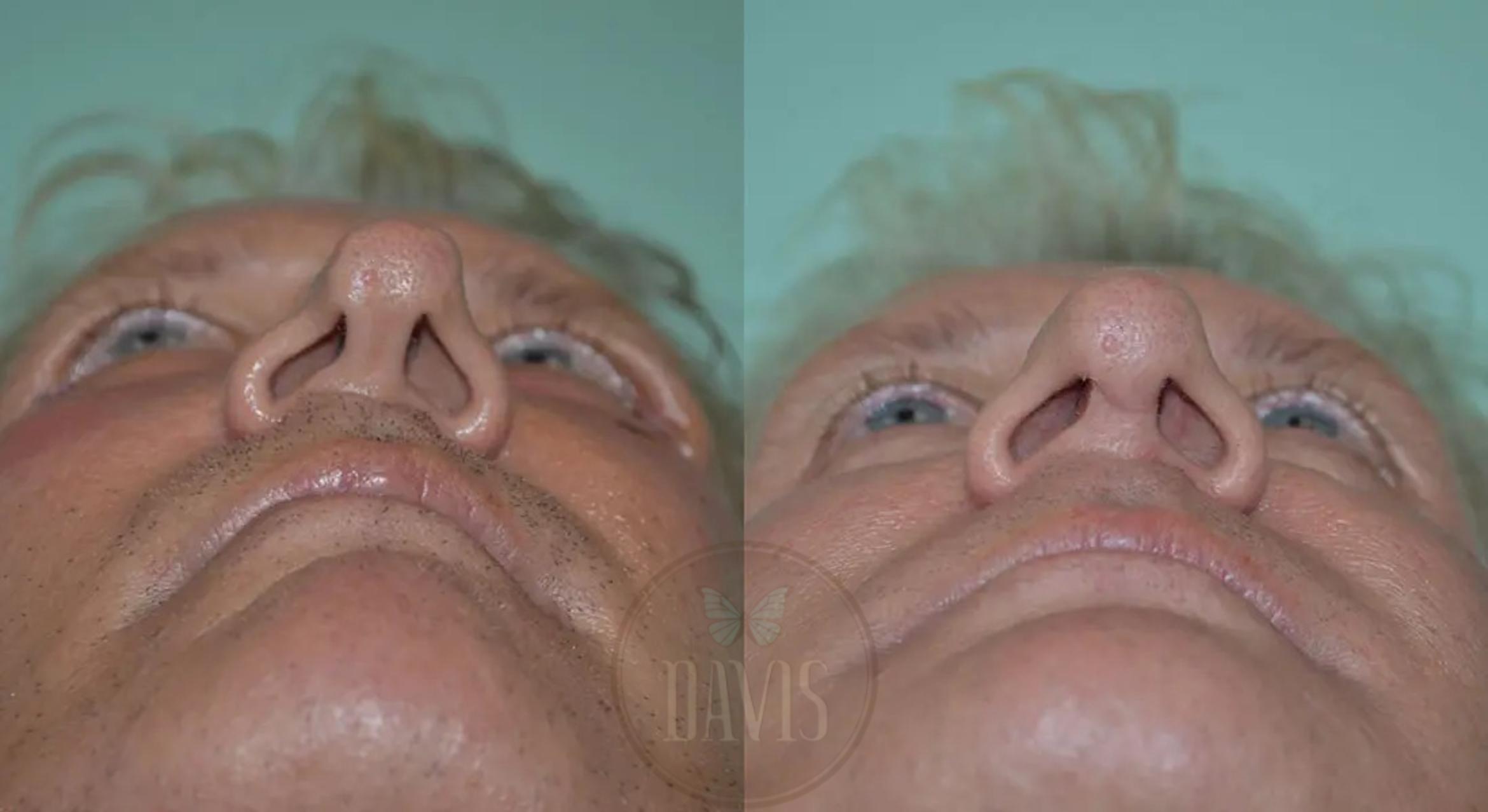 Before & After Revision Rhinoplasty Case 1023 View 2 View in Tampa, FL