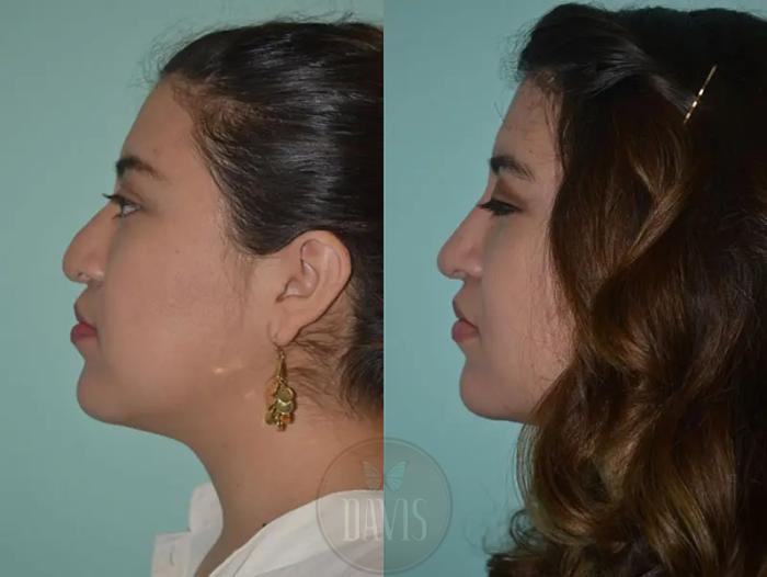 Before & After Revision Rhinoplasty Case 1024 View 1 View in Tampa, FL