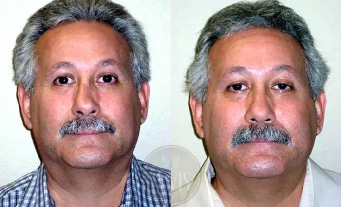 Before & After Revision Rhinoplasty Case 1025 View 1 View in Tampa, FL