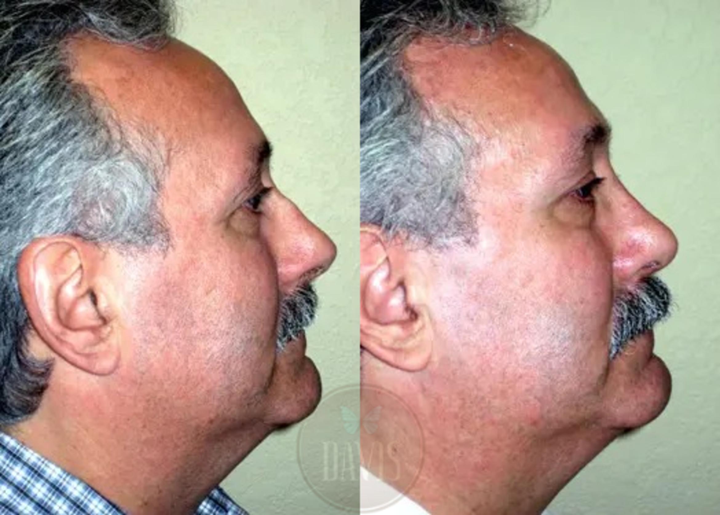Before & After Revision Rhinoplasty Case 1025 View 2 View in Tampa, FL