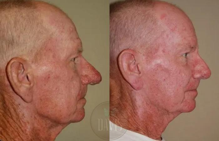 Before & After Rhinophyma Case 1018 View 1 View in Tampa, FL