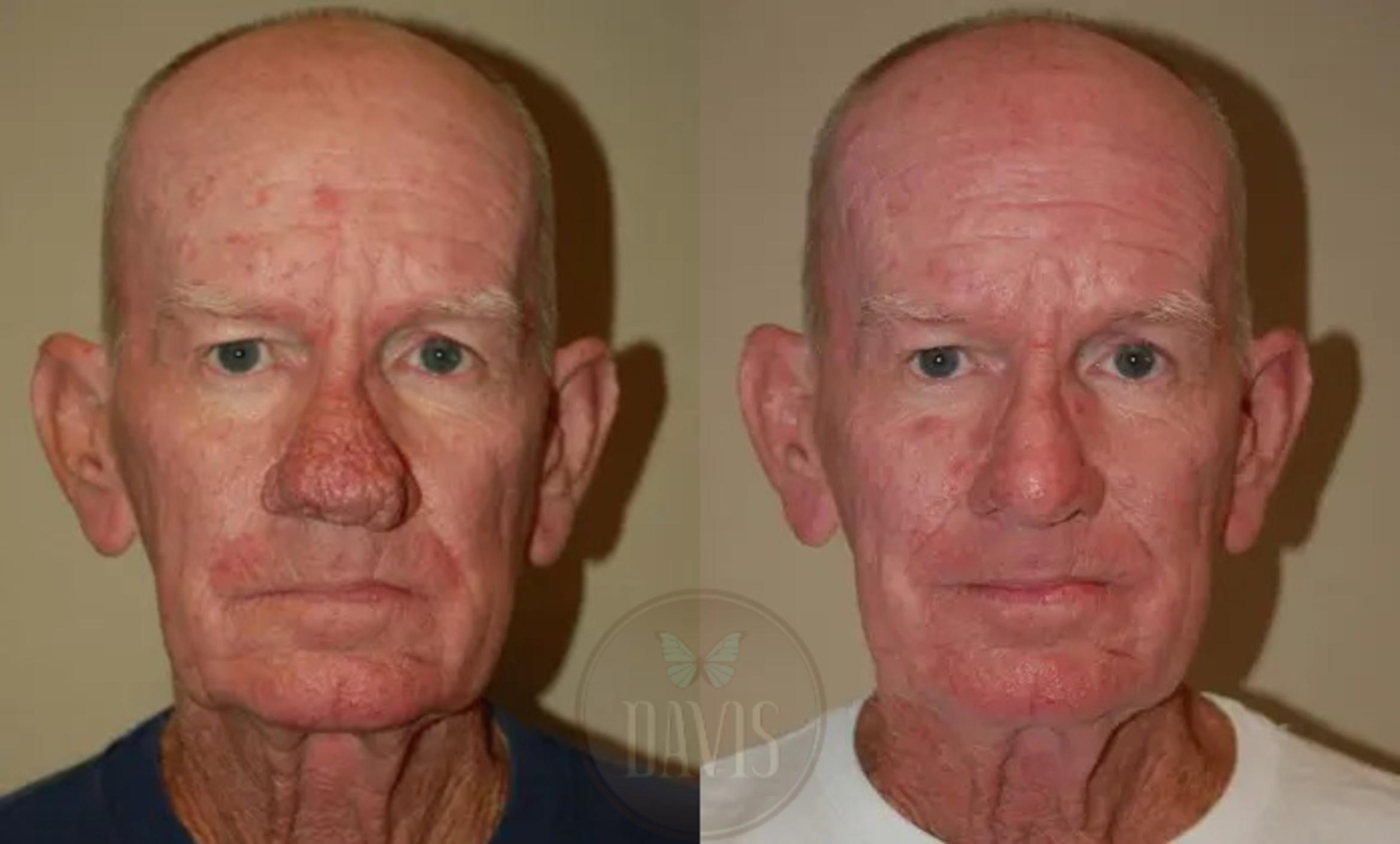 Before & After Rhinophyma Case 1018 View 2 View in Tampa, FL