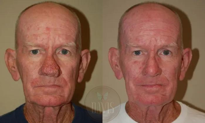 Before & After Rhinophyma Case 1018 View 2 View in Tampa, FL