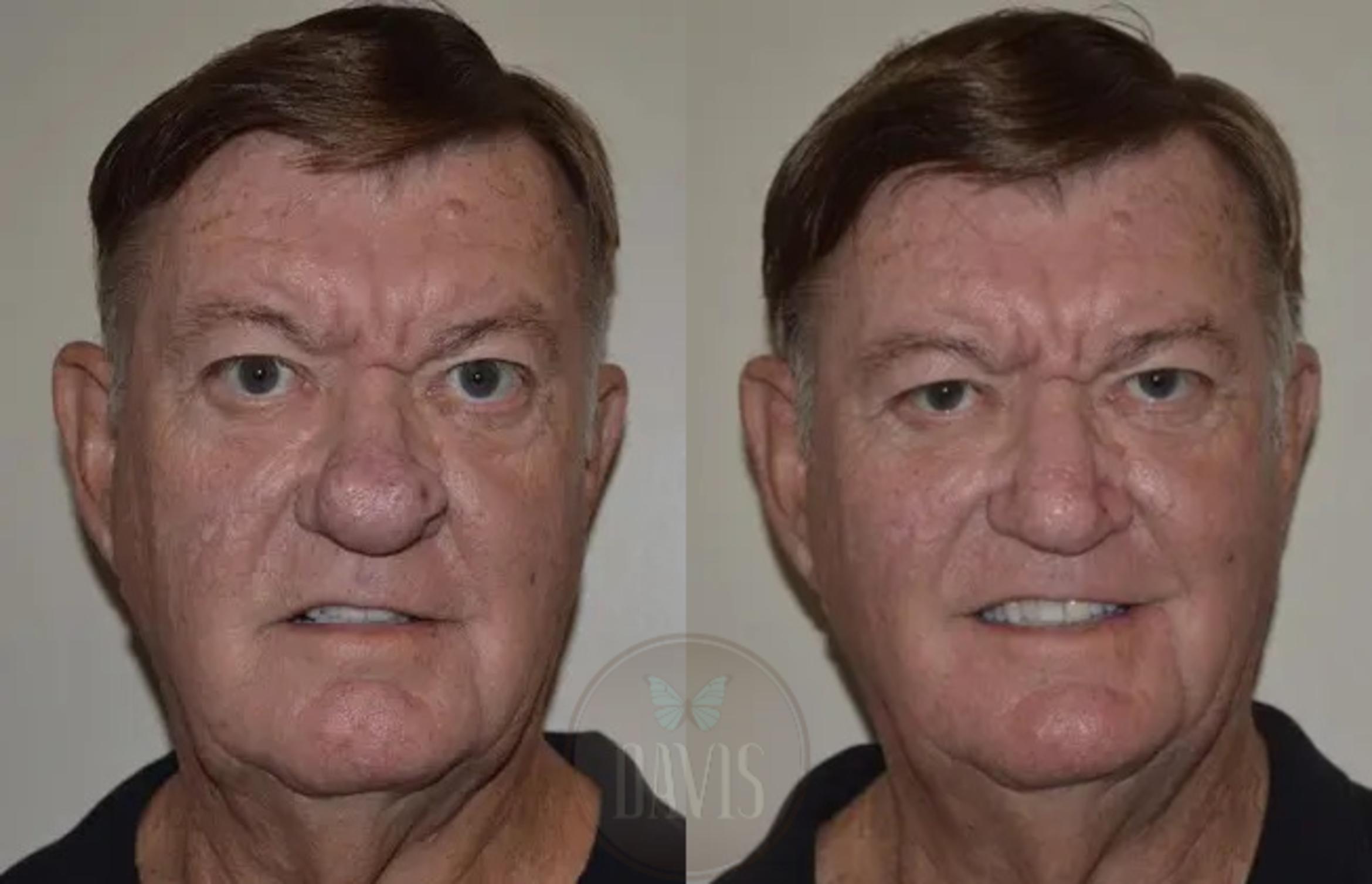 Rhinophyma Before and After Pictures Case 1019 | Tampa, FL | Davis ...