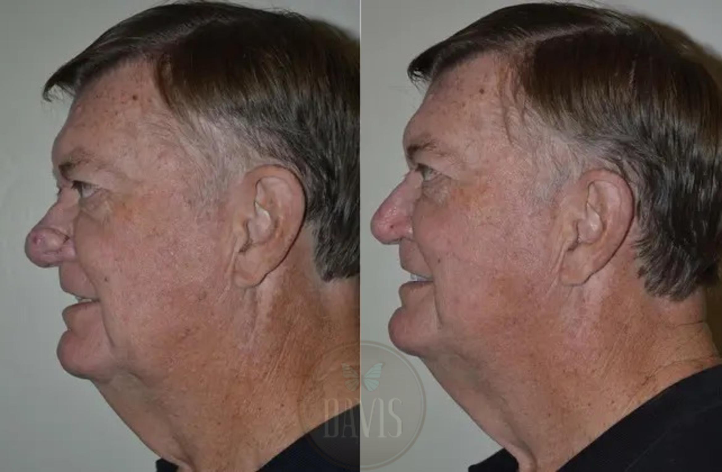 Before & After Rhinophyma Case 1019 View 2 View in Tampa, FL