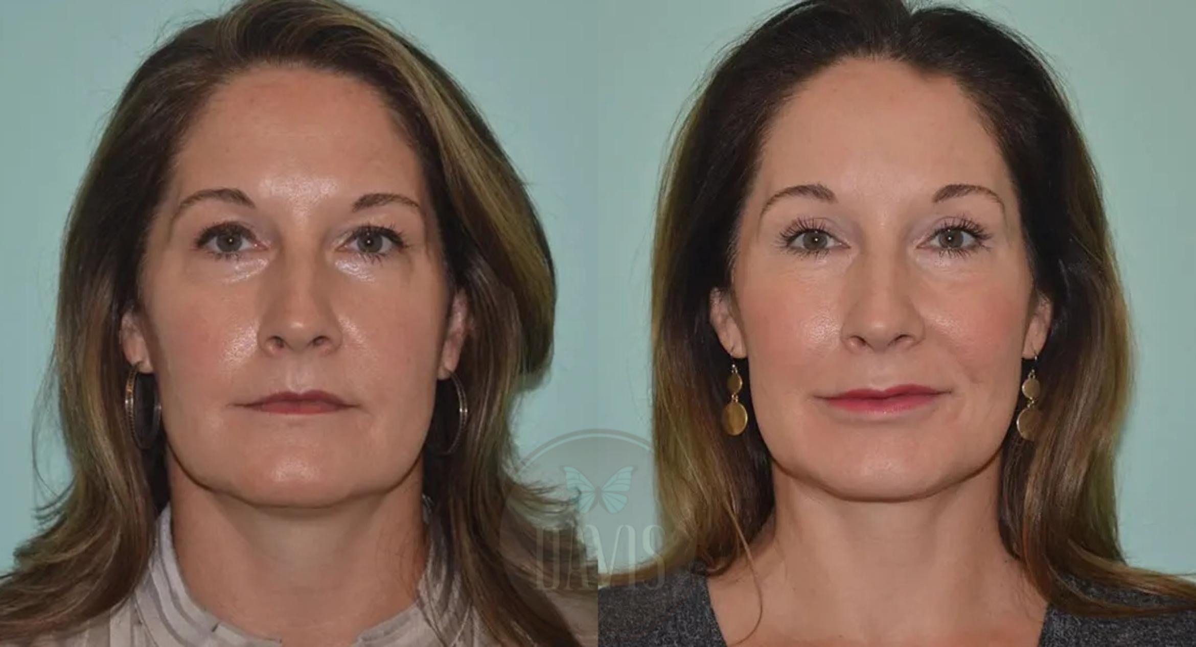 Before & After Upper Eyelid Lift/Blepharoplasty Case 1010 View 1 View in Tampa, FL