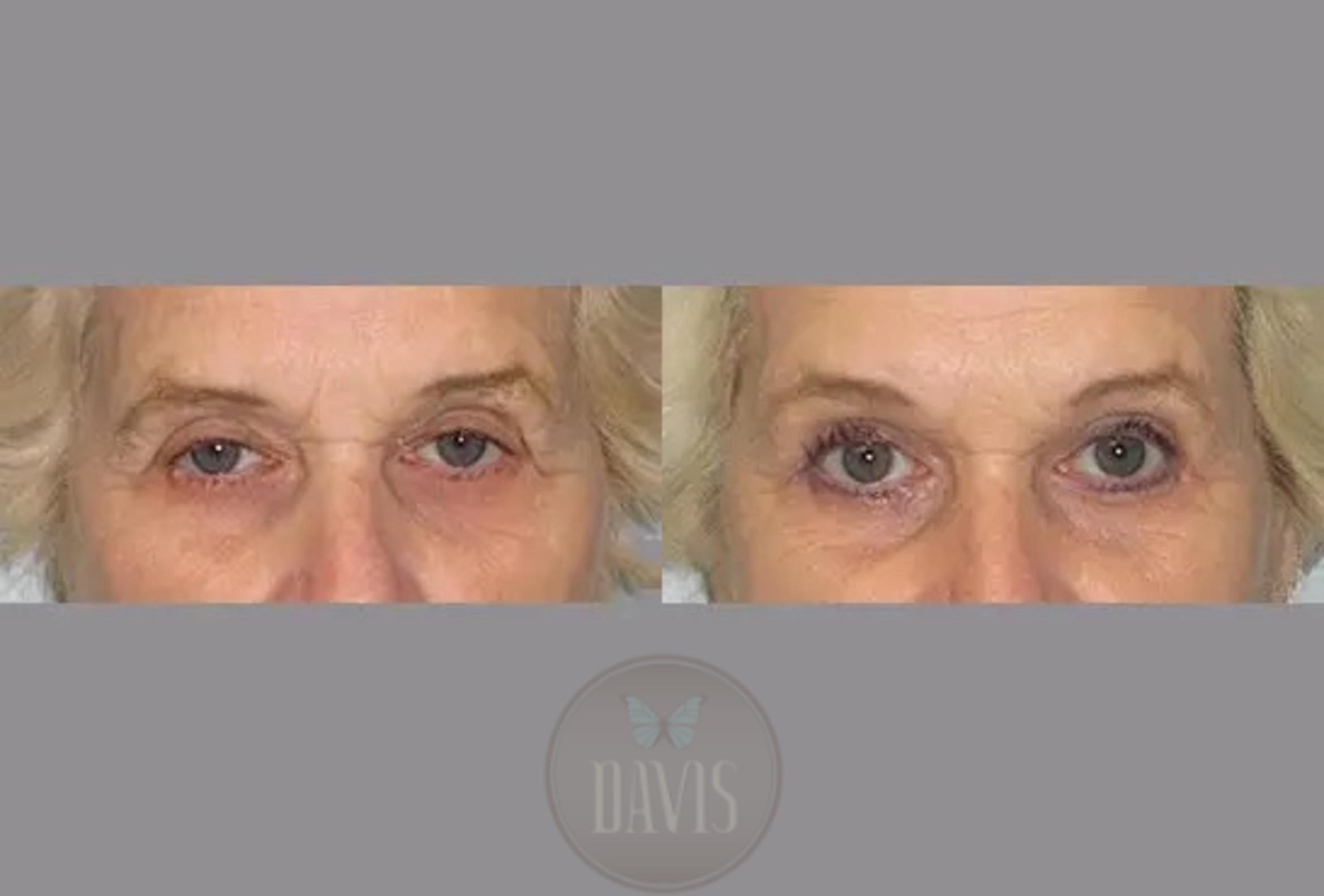 Before & After Upper Eyelid Lift/Blepharoplasty Case 1012 View 1 View in Tampa, FL
