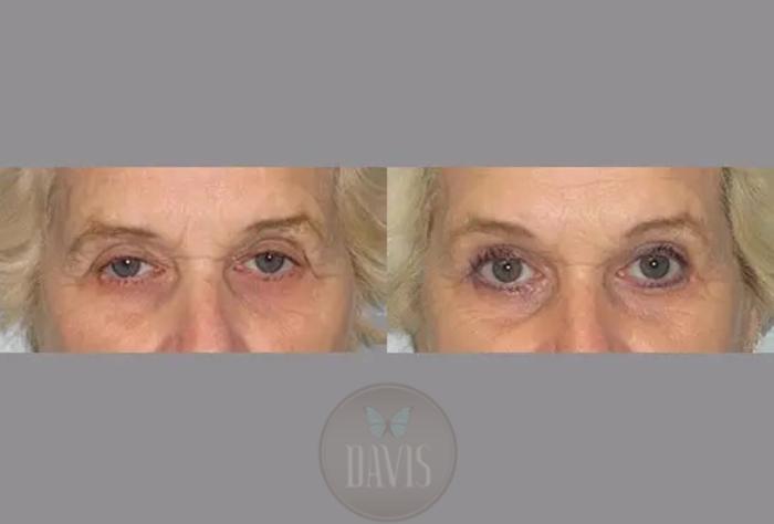 Before & After Upper Eyelid Lift/Blepharoplasty Case 1012 View 1 View in Tampa, FL