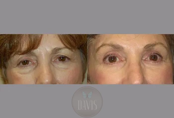 Before & After Lower Eyelid Lift/Blepharoplasty Case 1013 View 1 View in Tampa, FL