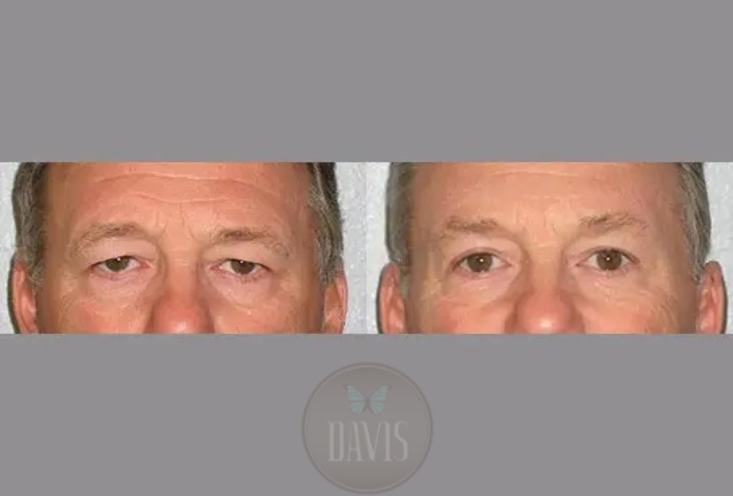 Before & After Upper Eyelid Lift/Blepharoplasty Case 1014 View 1 View in Tampa, FL