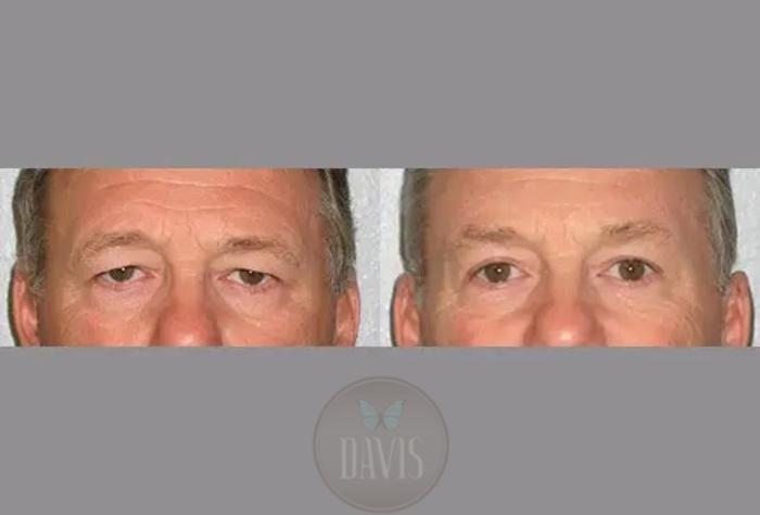 Before & After Upper Eyelid Lift/Blepharoplasty Case 1014 View 1 View in Tampa, FL