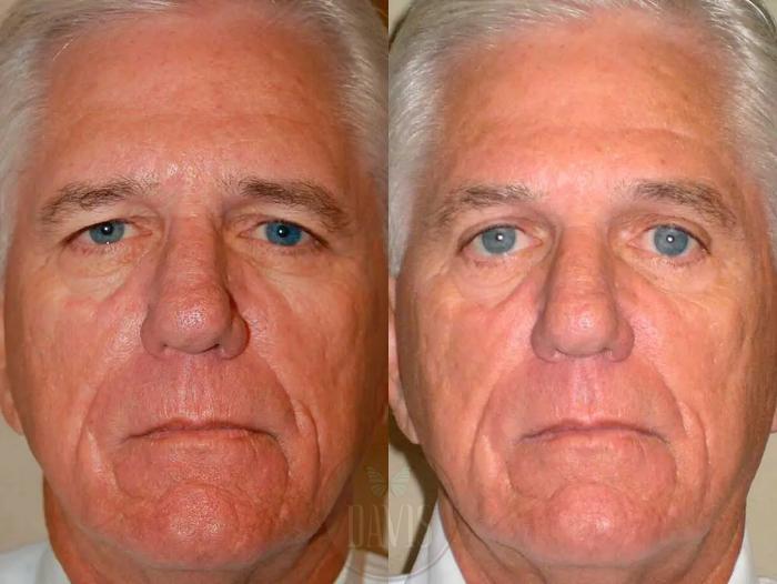 Before & After Upper Eyelid Lift/Blepharoplasty Case 1015 View 1 View in Tampa, FL