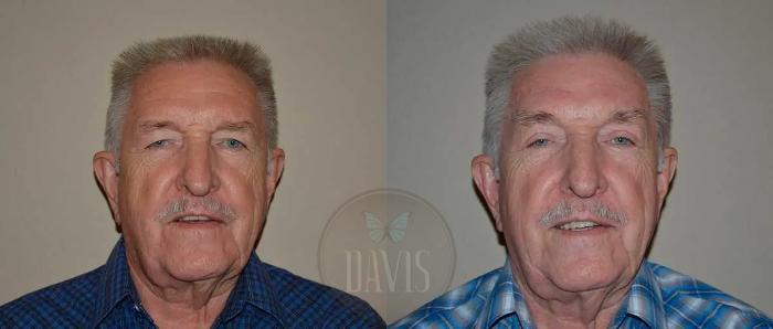 Before & After Upper Eyelid Lift/Blepharoplasty Case 1016 View 1 View in Tampa, FL