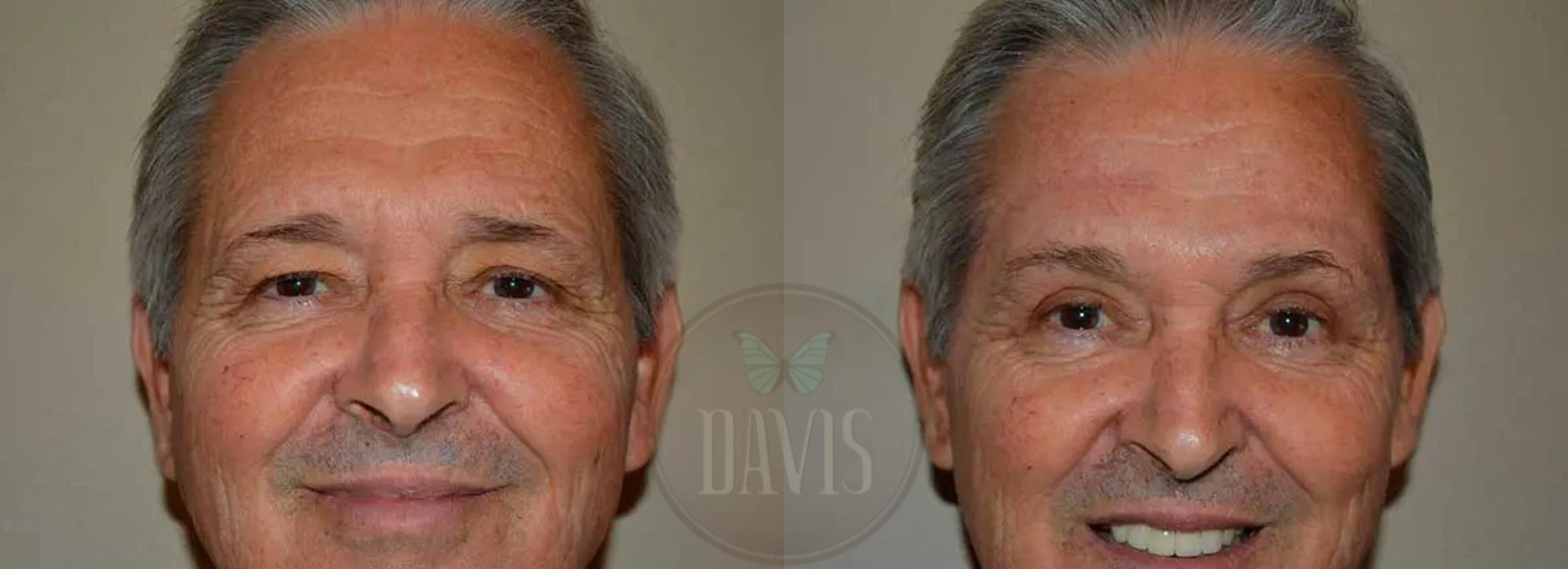 Before & After Upper Eyelid Lift/Blepharoplasty Case 1017 View 1 View in Tampa, FL