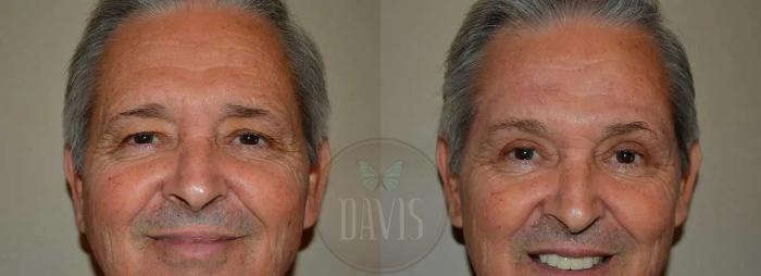 Before & After Upper Eyelid Lift/Blepharoplasty Case 1017 View 1 View in Tampa, FL