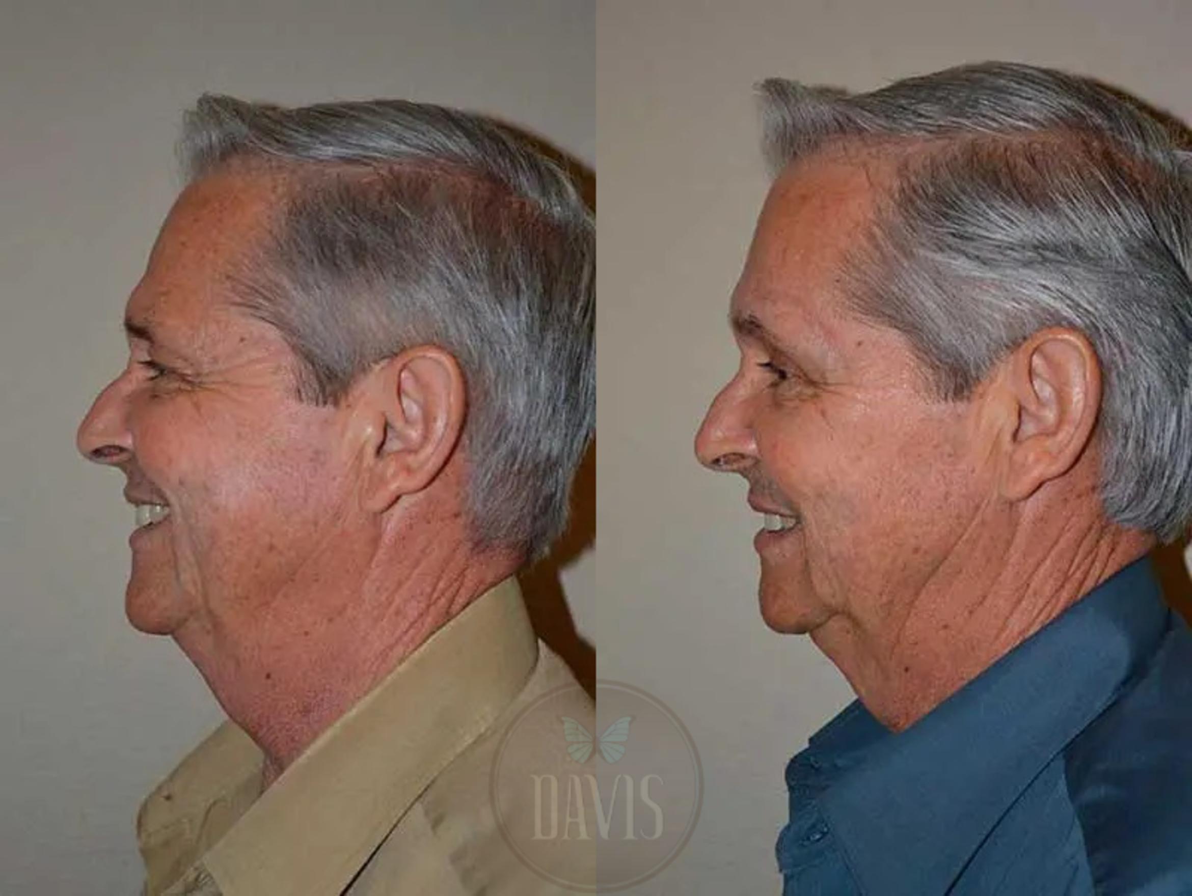 Before & After Upper Eyelid Lift/Blepharoplasty Case 1017 View 2 View in Tampa, FL