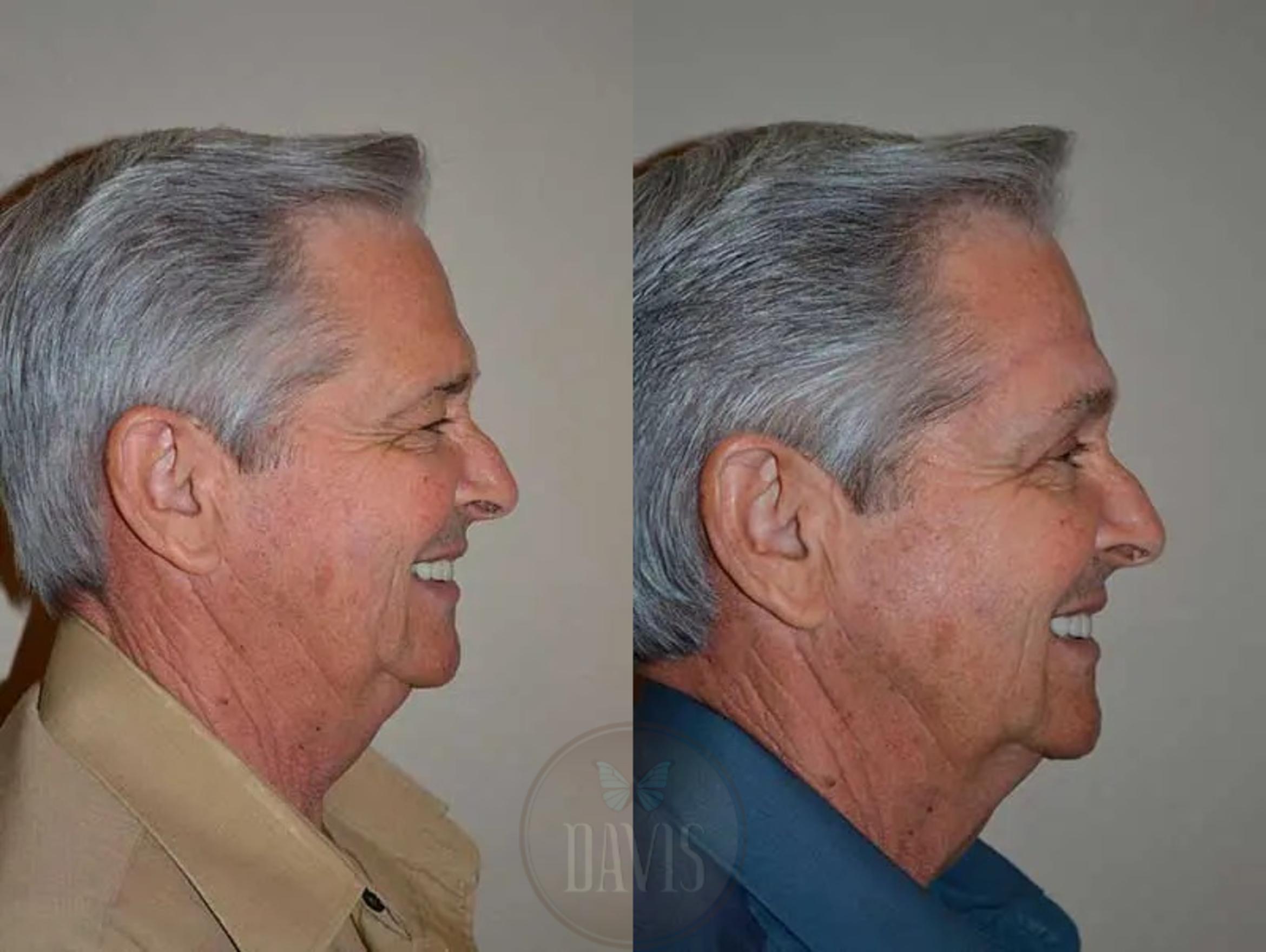 Before & After Upper Eyelid Lift/Blepharoplasty Case 1017 View 3 View in Tampa, FL